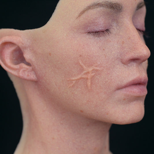 Dynamic Keloid Scar 1