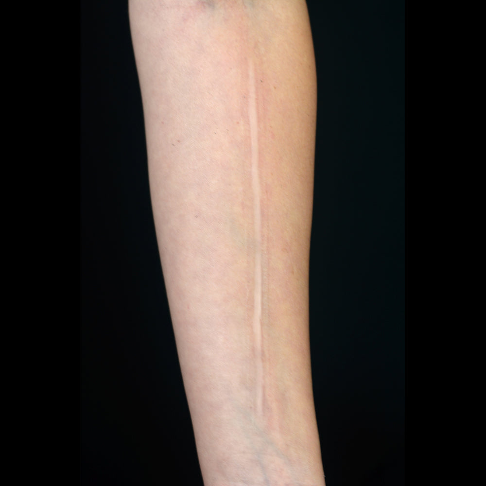 Laser cut Keloid Scar