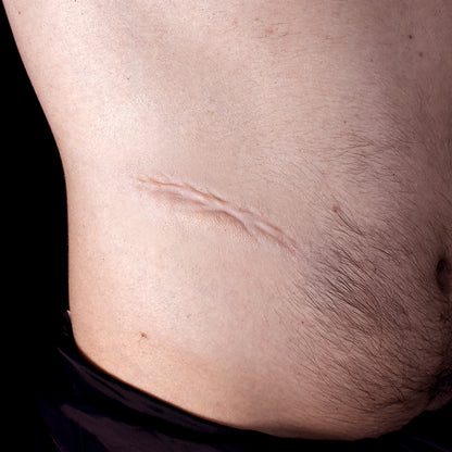 Stomach scar