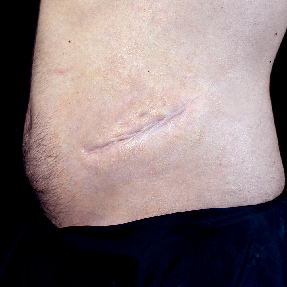 Large stomach scar