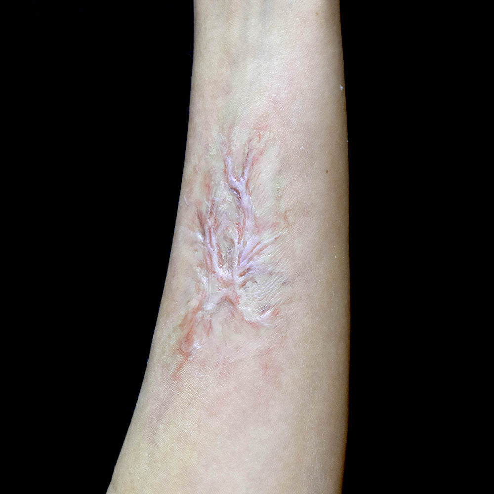Healed Burn Scar 3