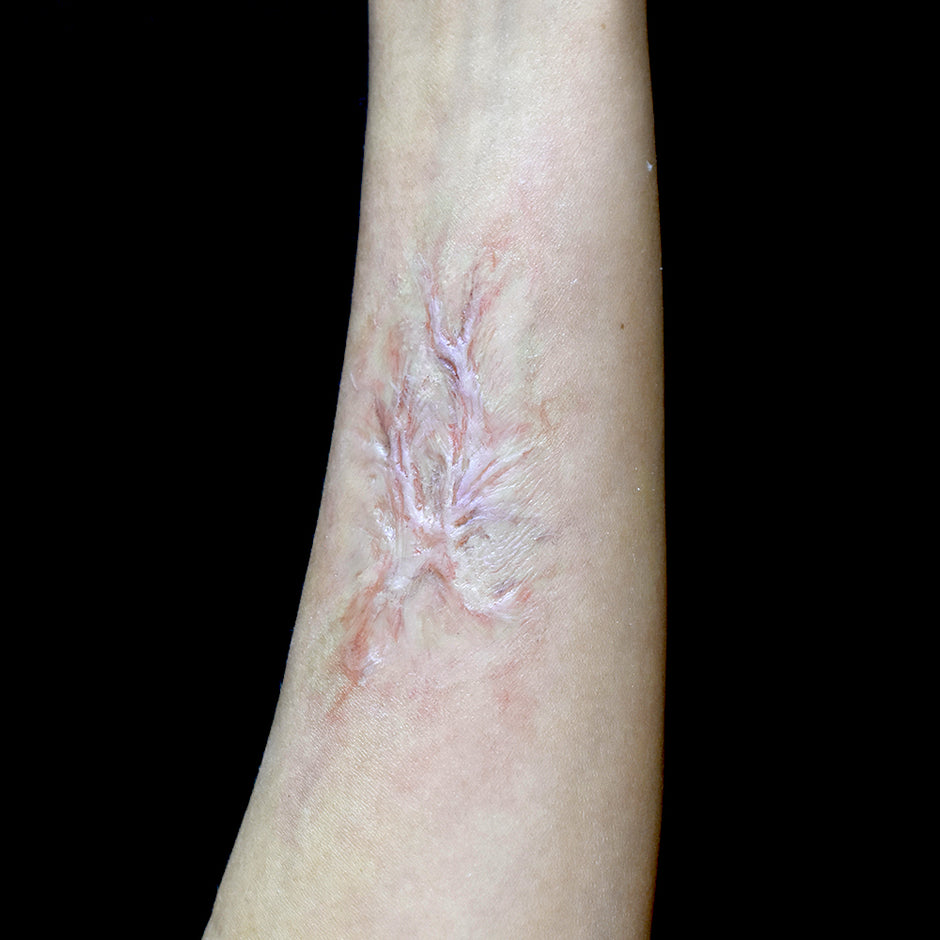 Scar Prothesis TRADITIONAL PROSTHETICS – Out of Kit