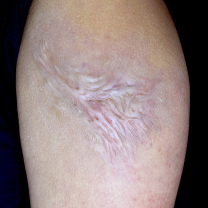 cigarette burn scar healed How to Heal a Burn: 9 Steps (with Pictures) 2nd Degree burn from cigarette: