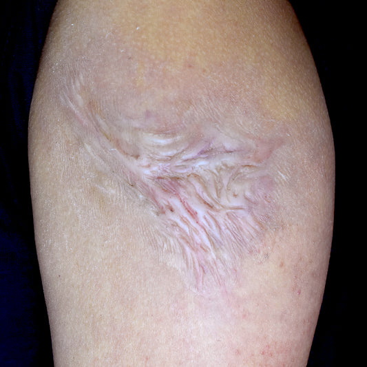 Healed Burn Scar 5