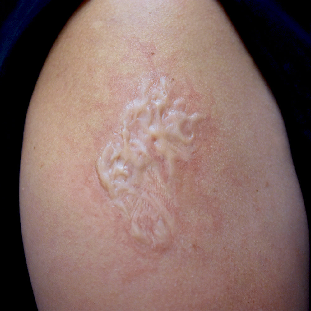 Road Rash Scar Ribs Road Rash 6 β Out of Kit