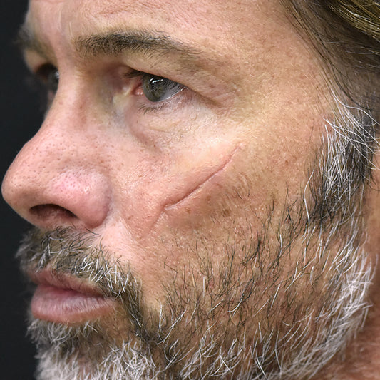 Scar Prothesis TRADITIONAL PROSTHETICS – Out of Kit