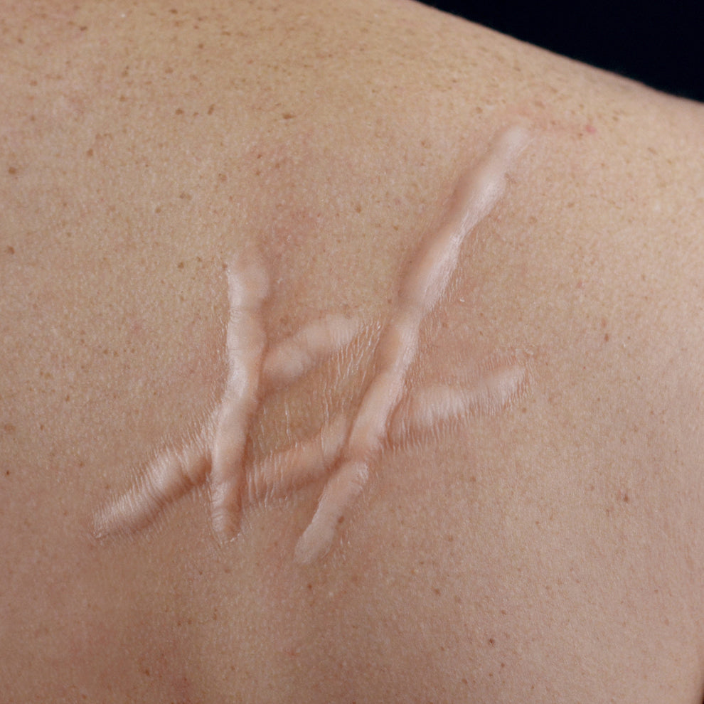 Puckered Incision Multiple Whip Scar (Large) – Out of Kit
