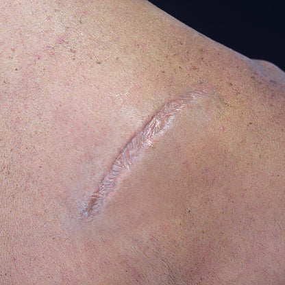 Medium Body Scar