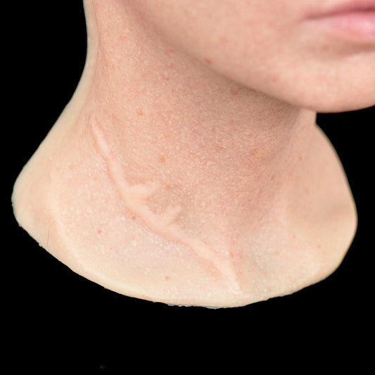 Split Keloid Scar